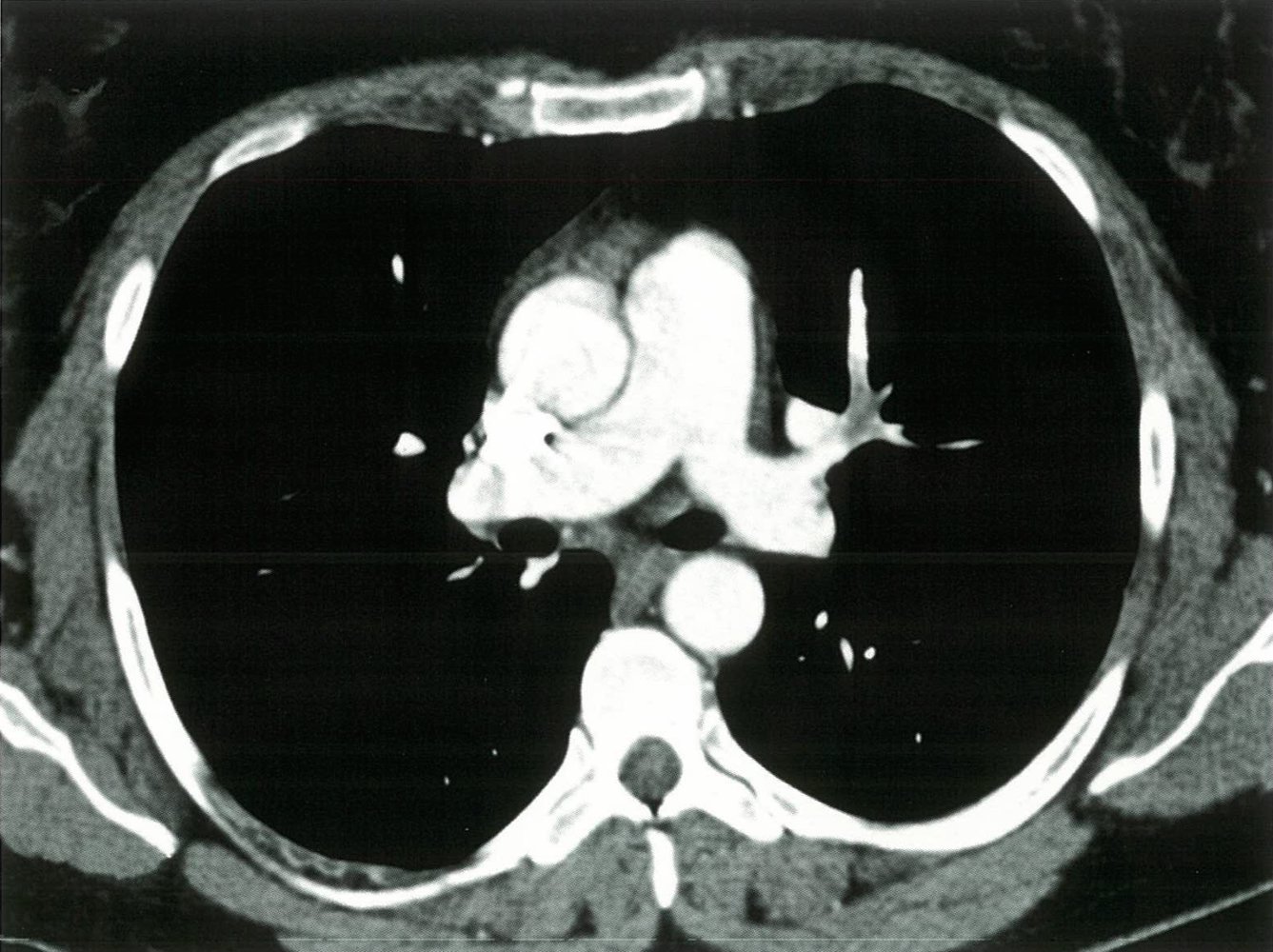 Occlusive pulmonary embolism