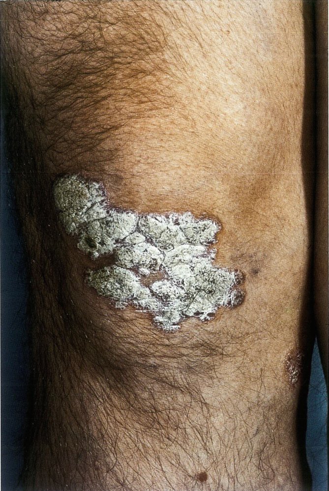 Plaque psoriasis