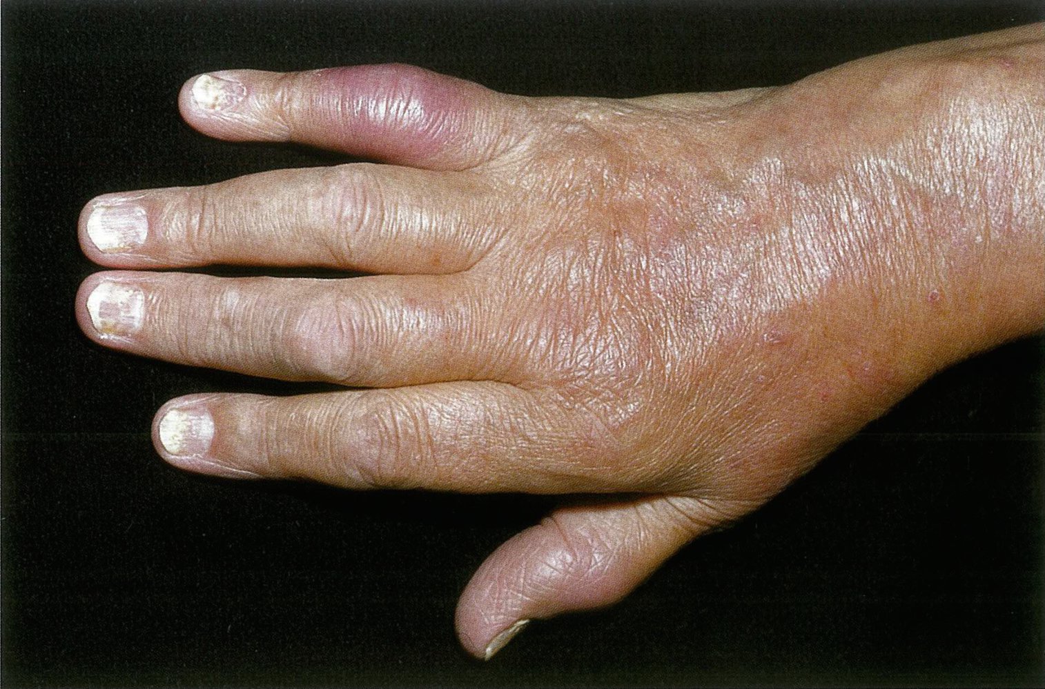 Psoriatic arthritis of the right hand