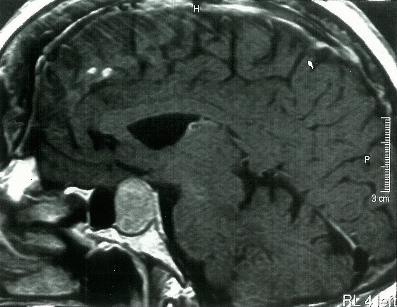 Tumor at the base of the skull