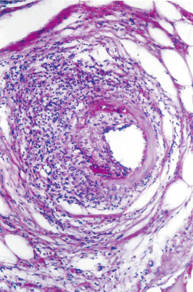 Polyarteritis nodosa