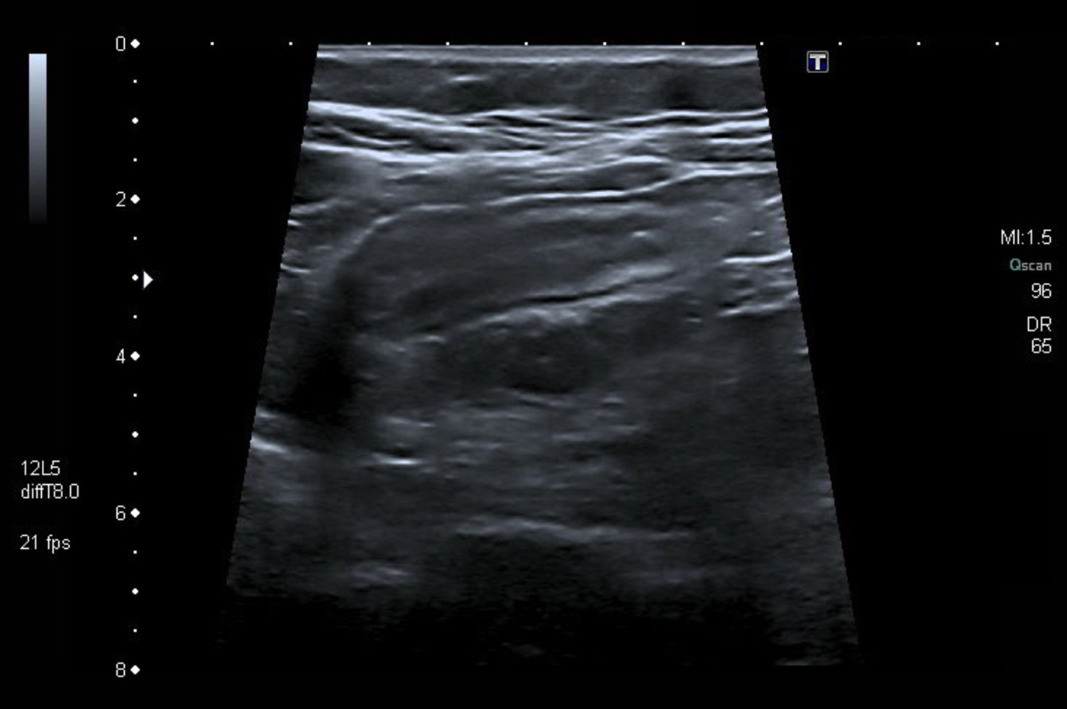 Acute appendicitis