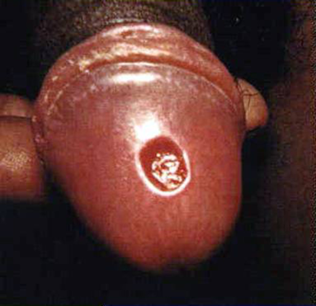 Chancre of the glans penis in primary syphilis
