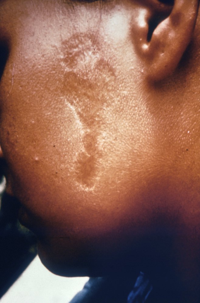Scar from cutaneous leishmaniasis