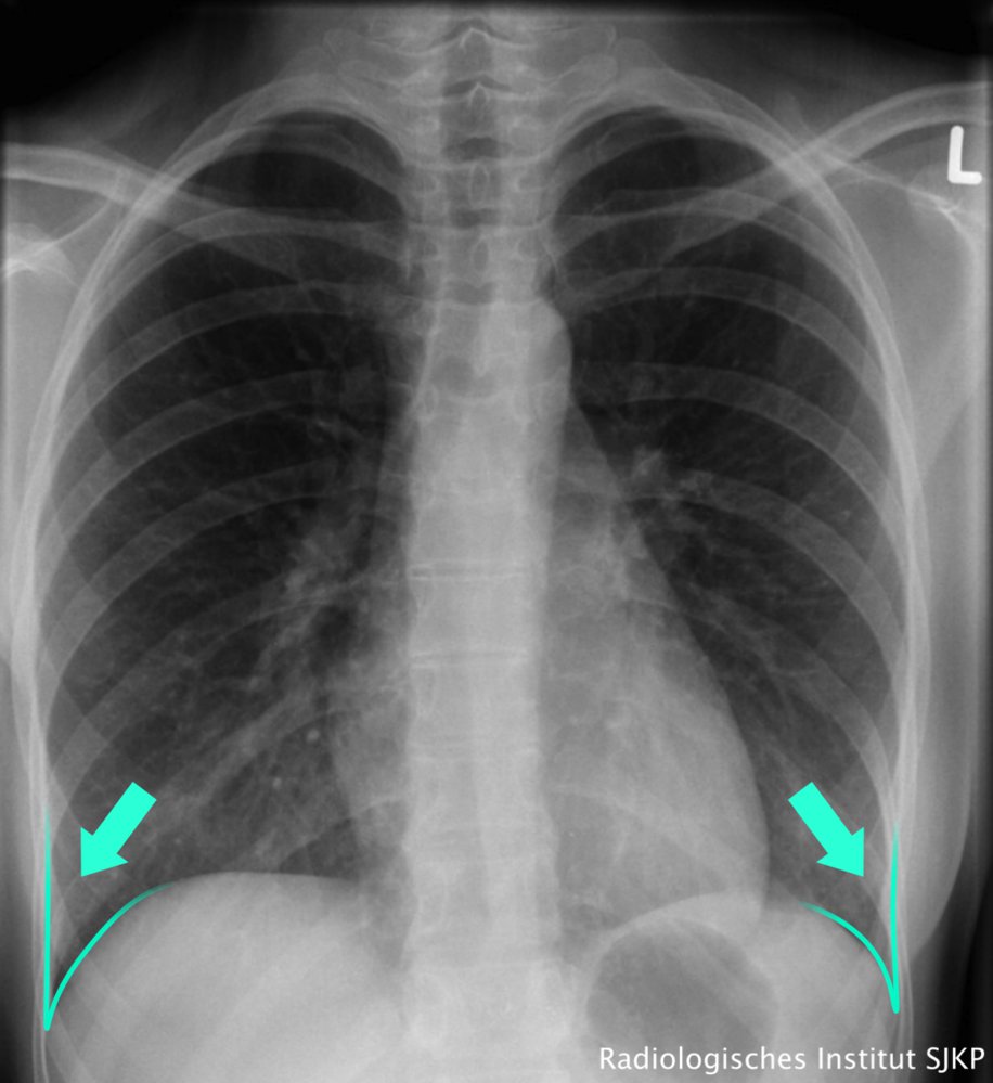 Normal costophrenic angles