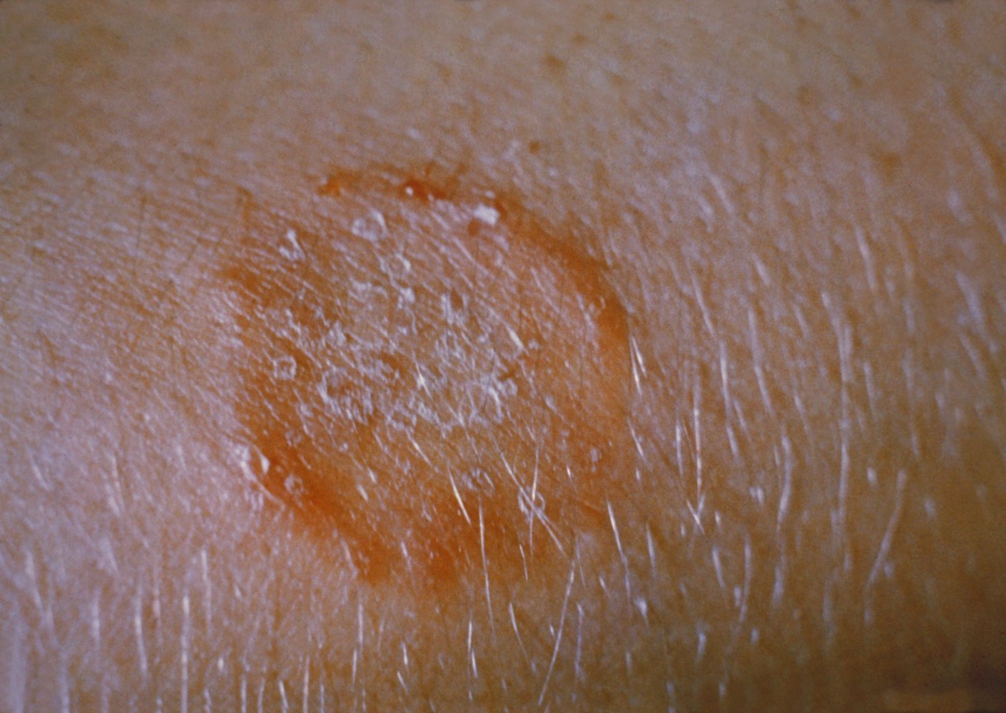 Tinea corporis