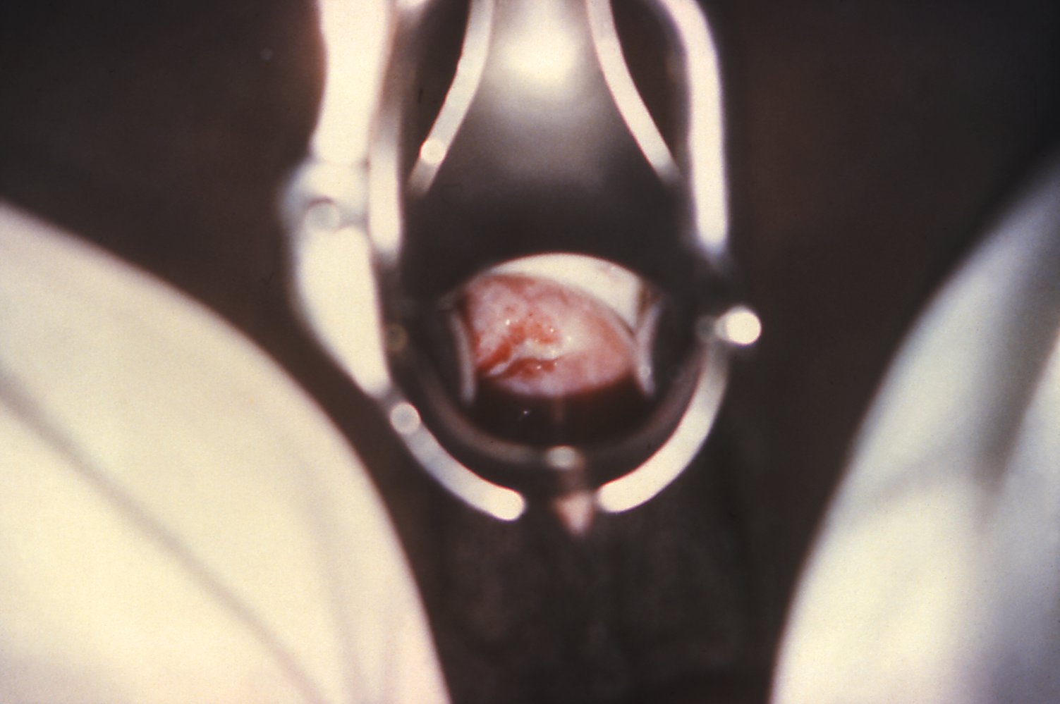 Cervical discharge in gonorrhea (speculum view)