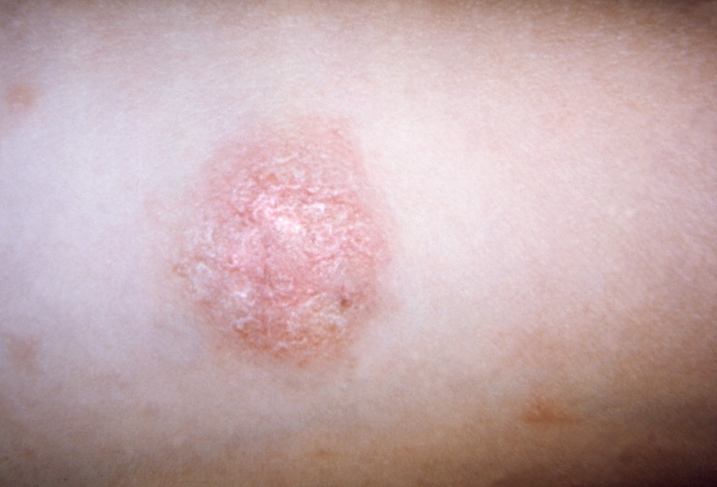 Herald patch (mother patch) in pityriasis rosea