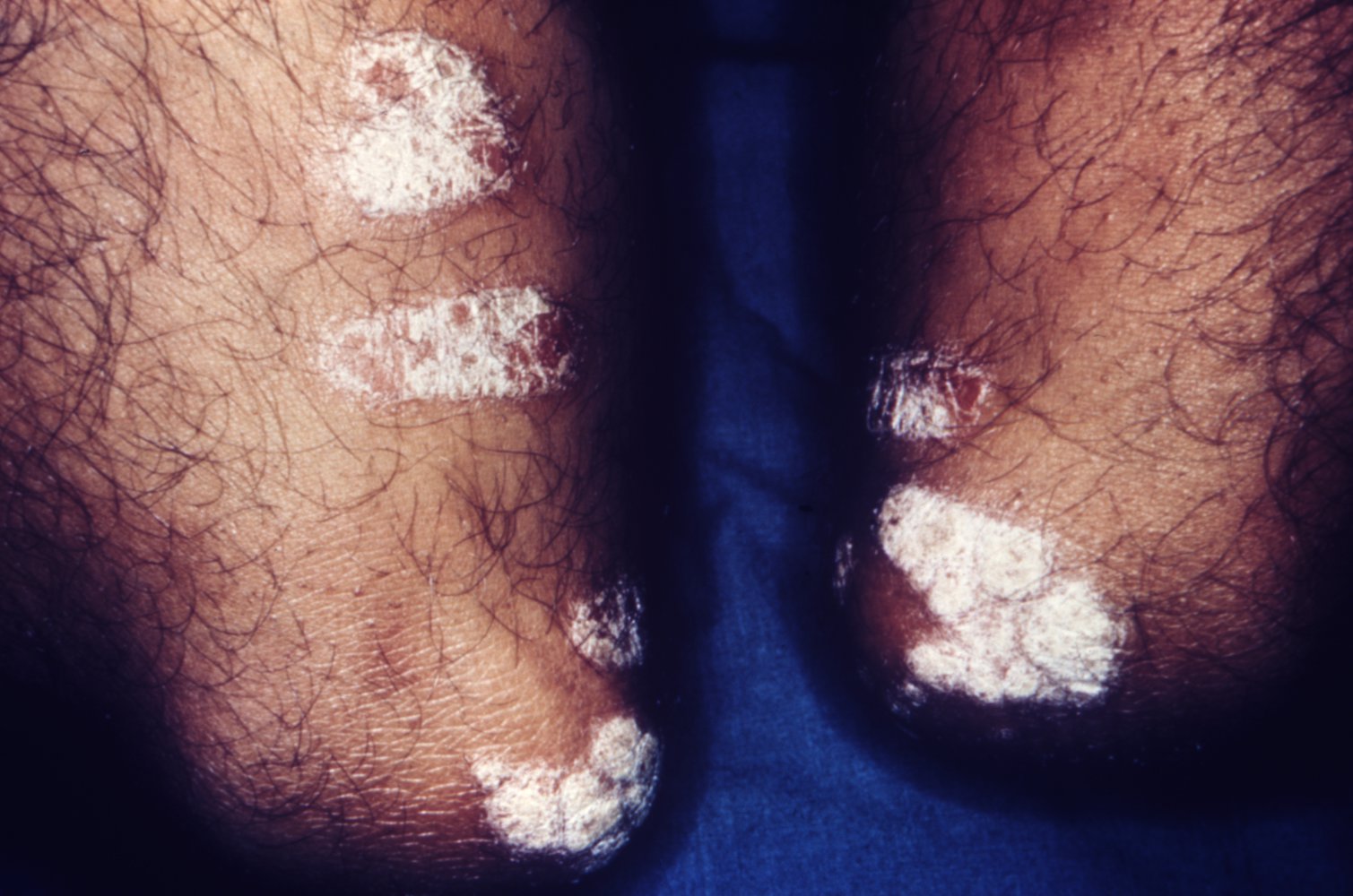 Plaque psoriasis
