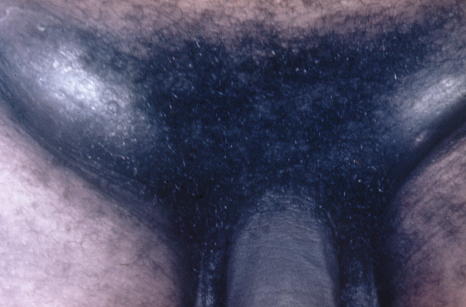Inguinal lymphadenopathy in chancroid