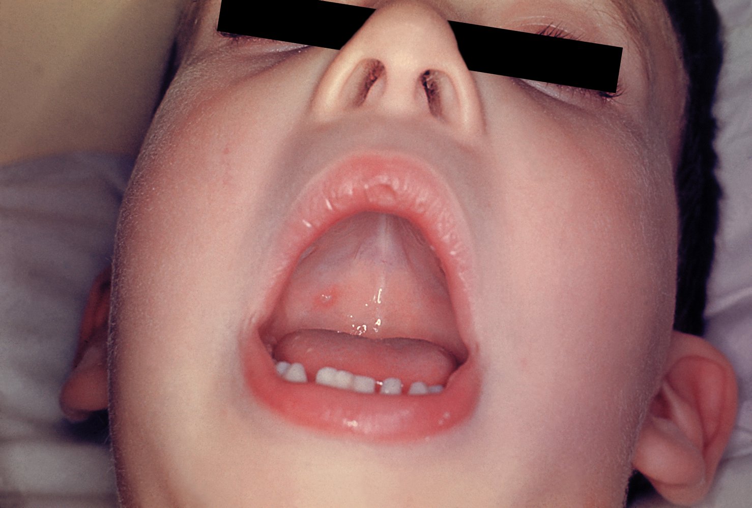 Enanthem of oral mucous membrane in chickenpox