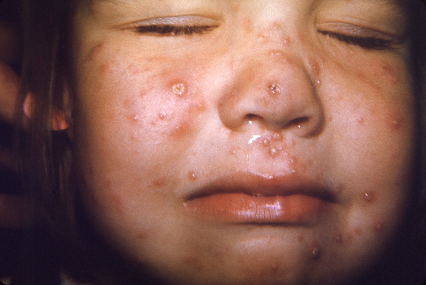 Facial rash in chickenpox