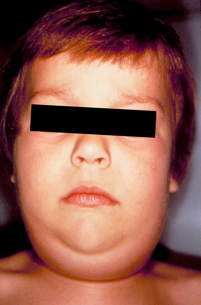 Sialadenitis in mumps