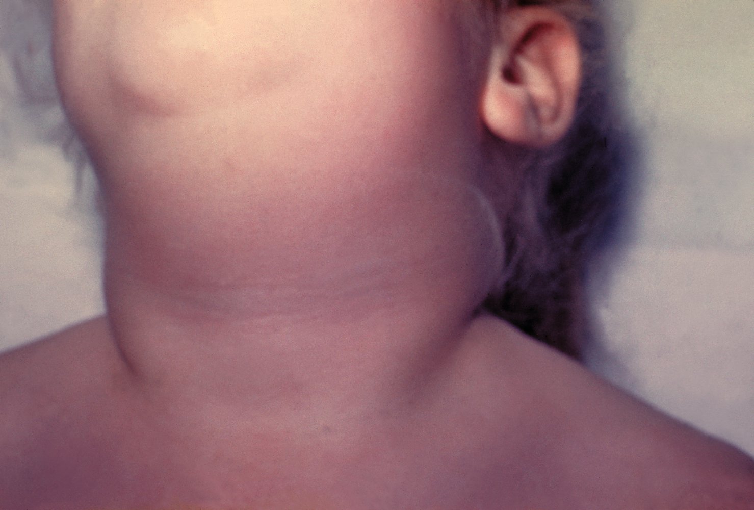 Neck swelling in mumps