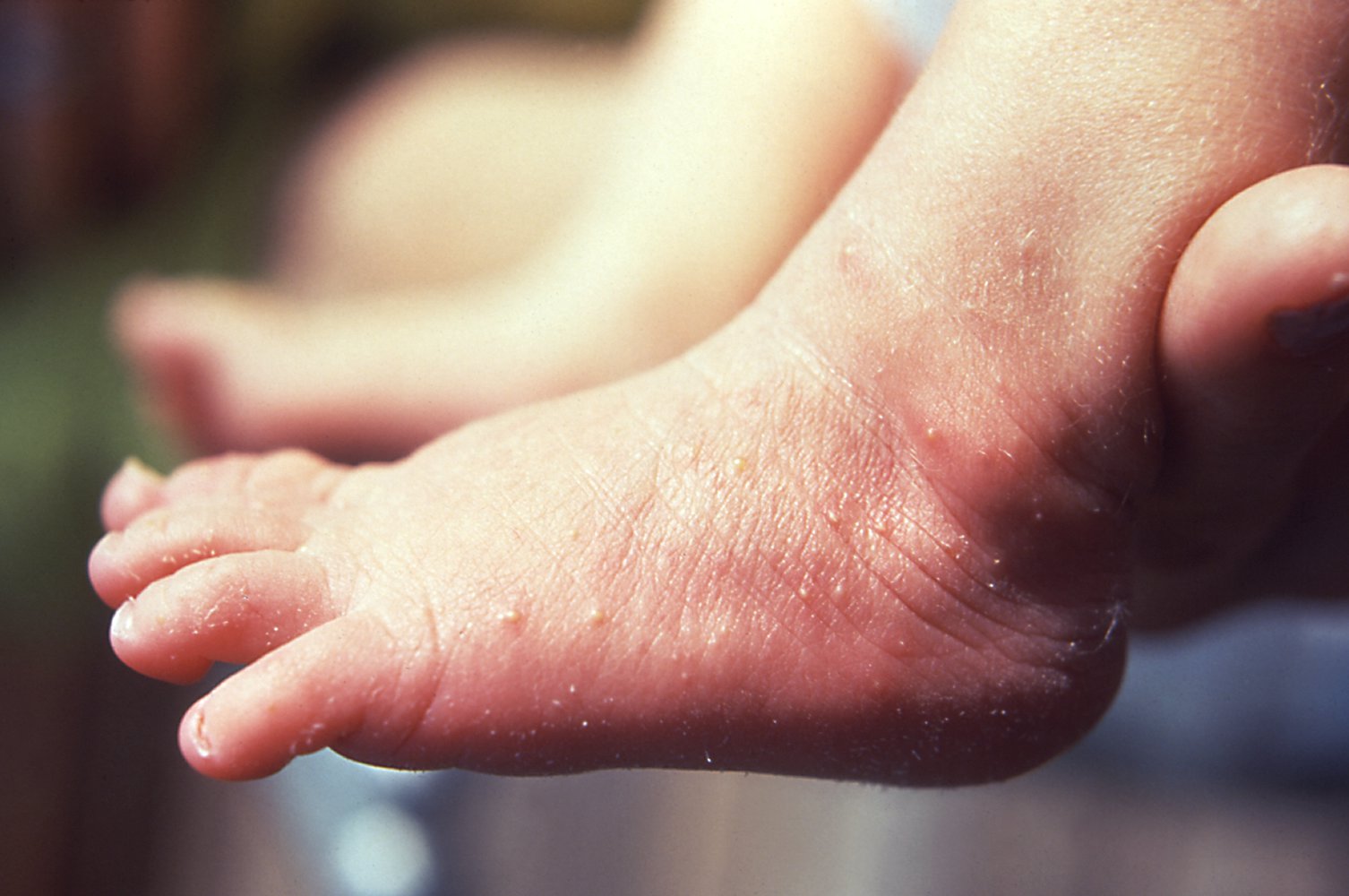 Erythema toxicum neonatorum