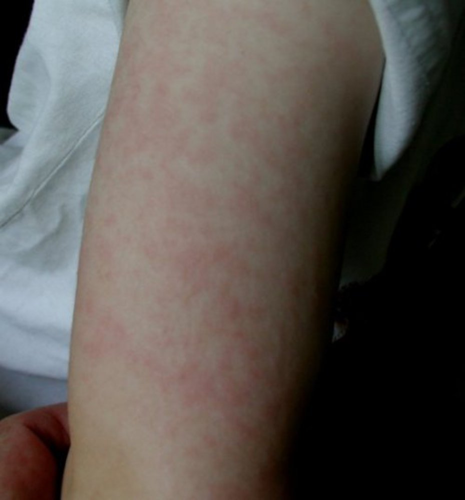 Erythema infectiosum