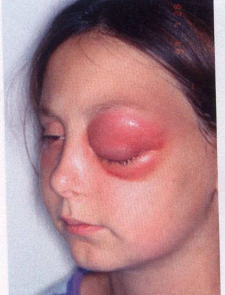 Orbital cellulitis