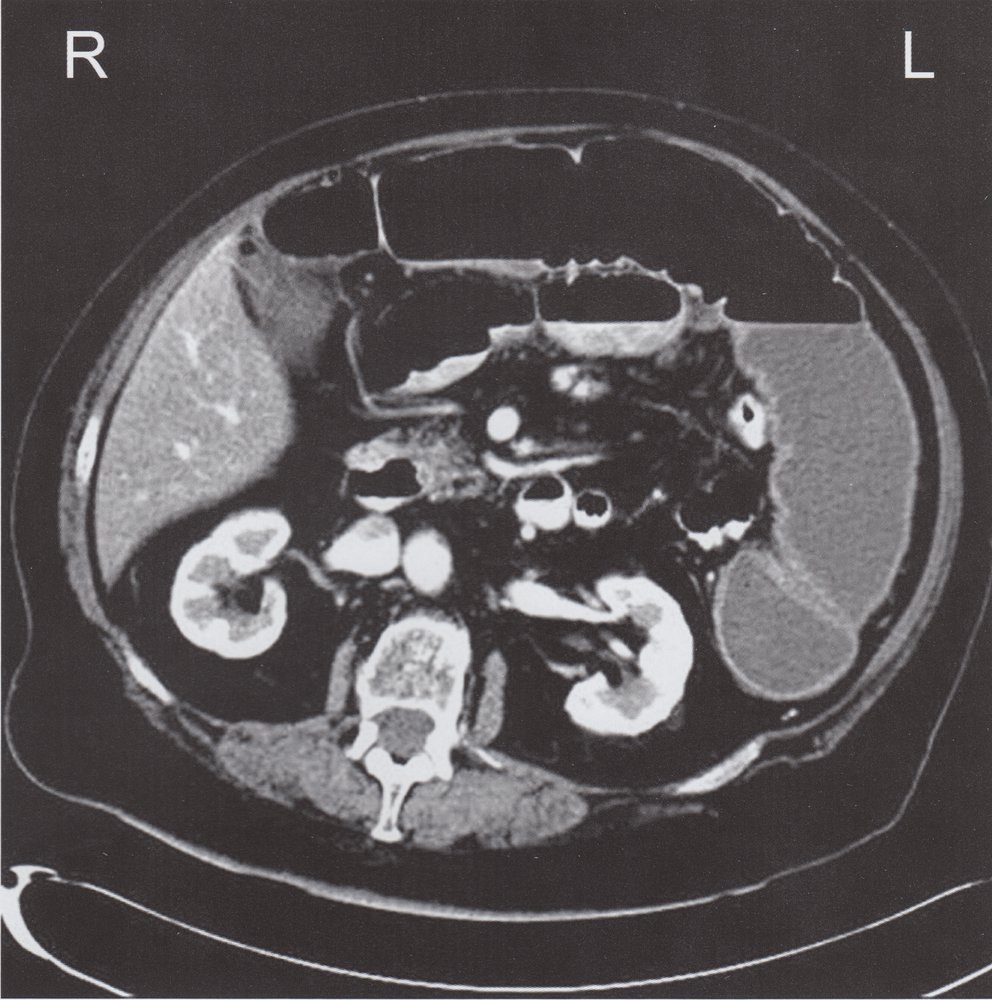 Intestinal obstruction from chronic diverticulitis (1/3)
