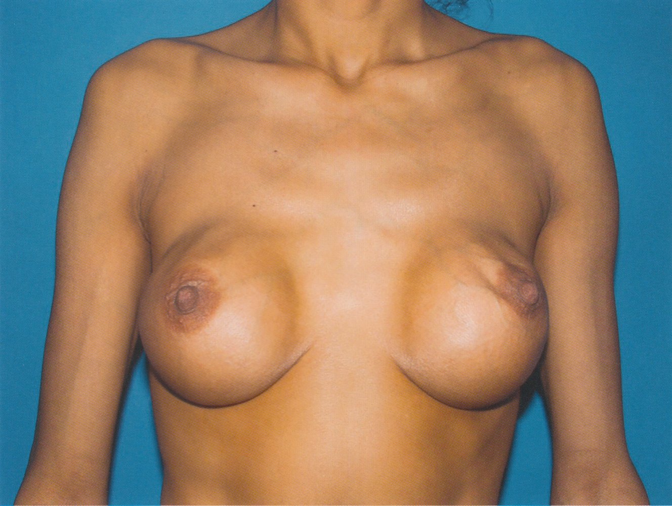 Bilateral capsular contracture after breast augmentation