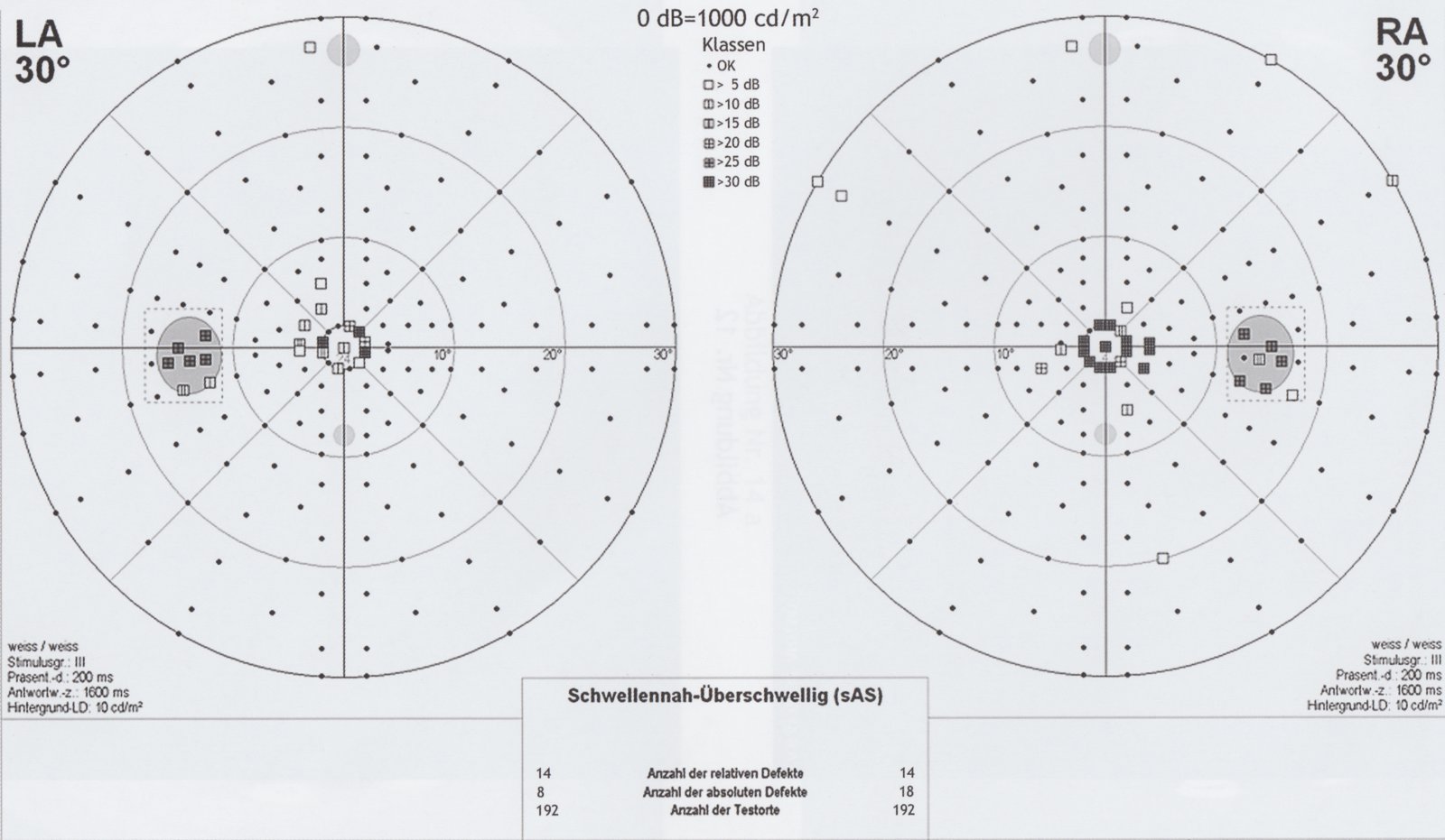 Bilateral central scotoma in perimetry