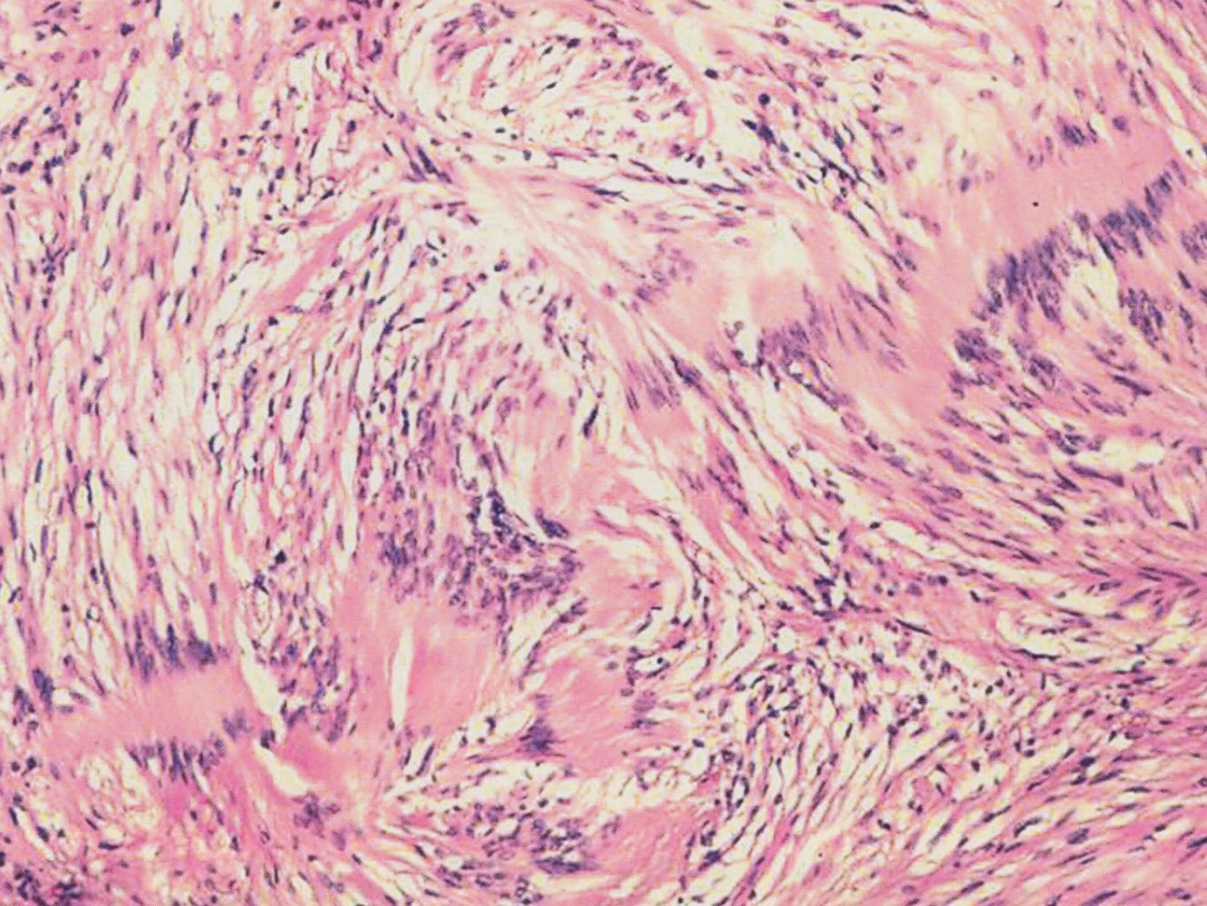 Acoustic neuroma in a 43-year-old patient
