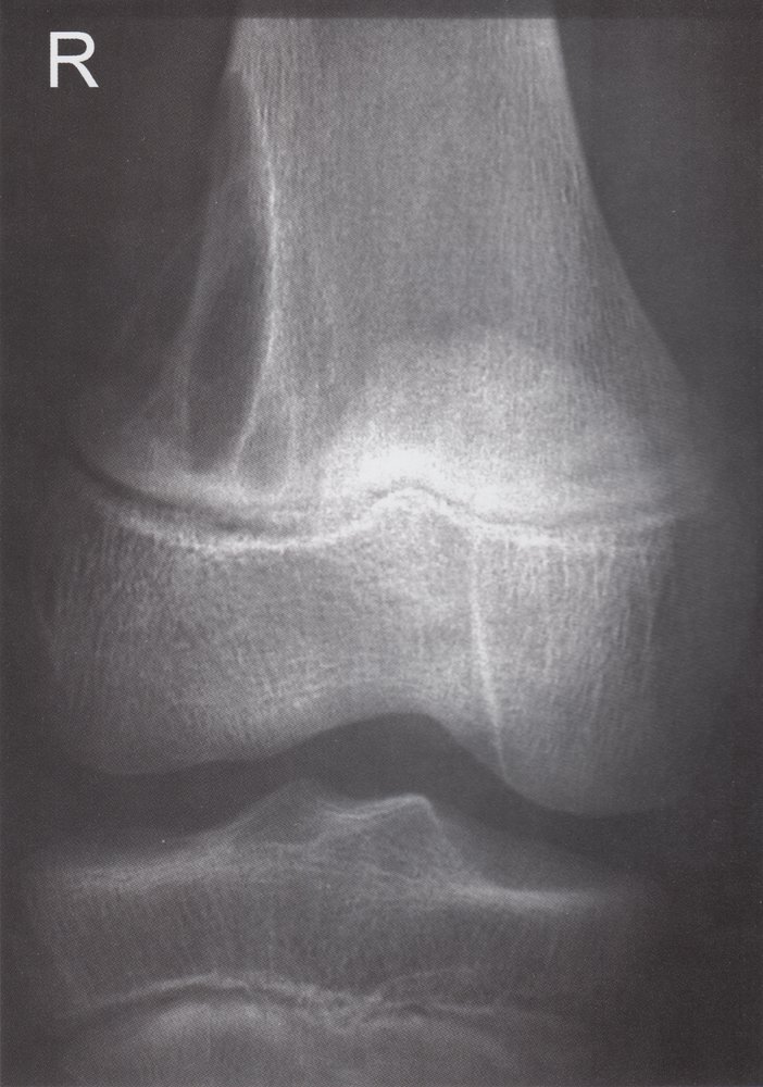 Aneurysmal bone cyst