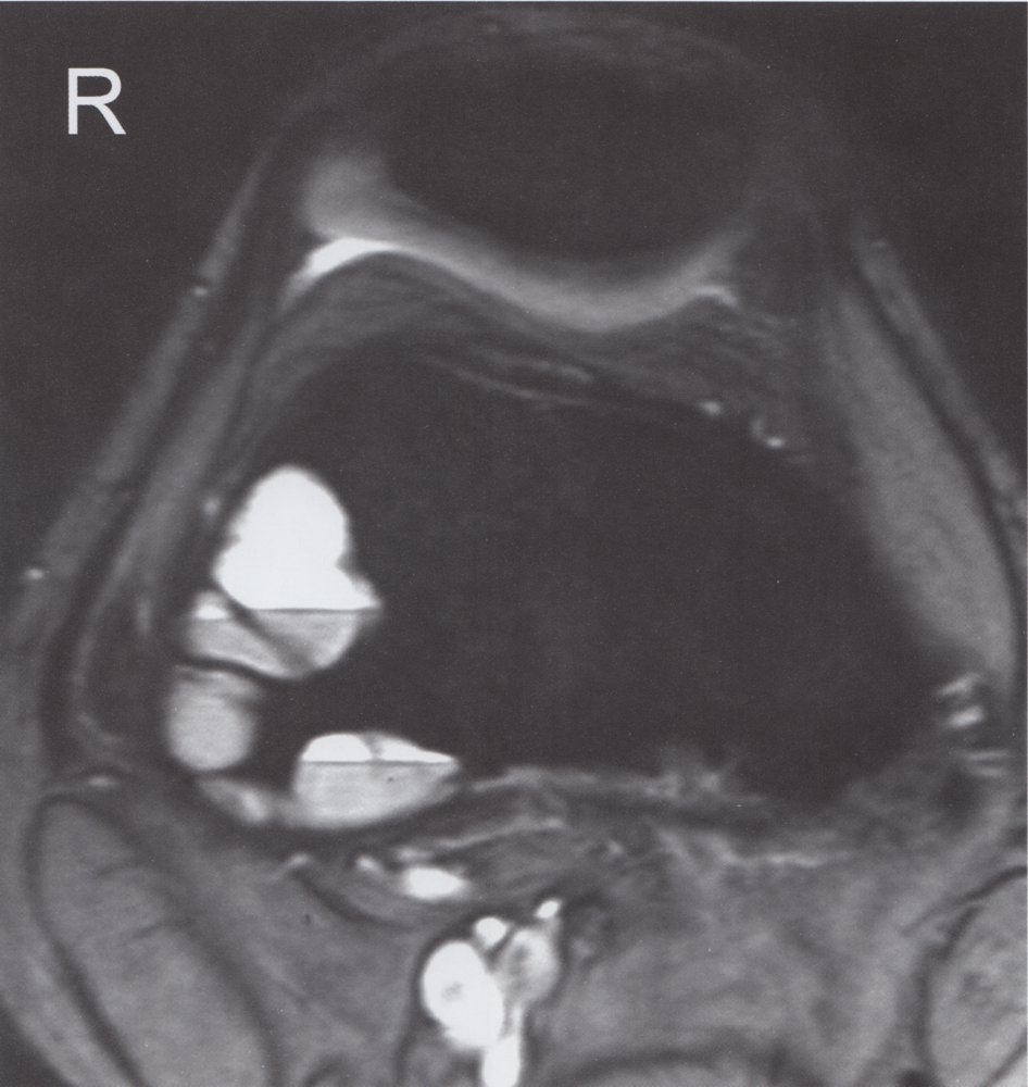 Aneurysmal bone cyst
