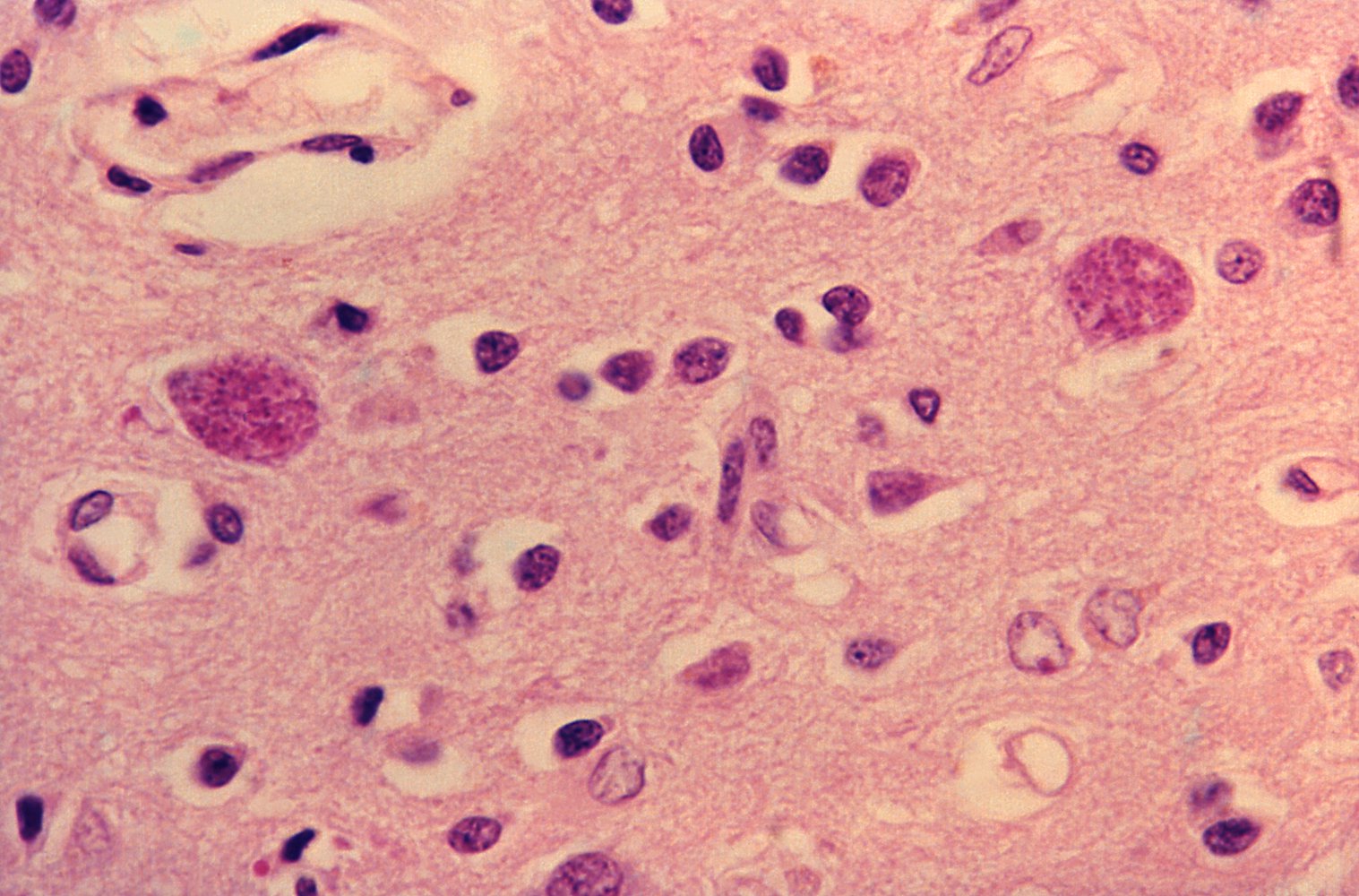 Toxoplasma gondii in brain tissue