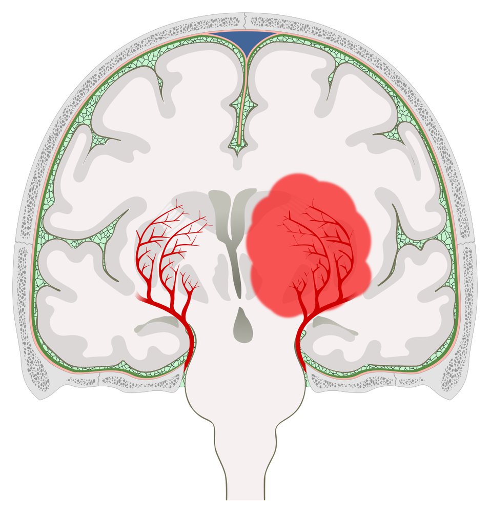 Basal ganglia hemorrhage