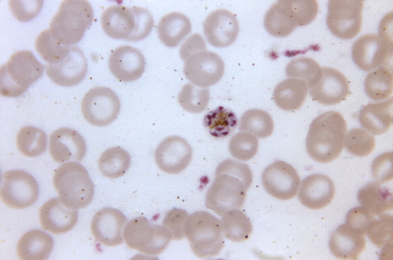 Mature schizont (Plasmodium malariae)