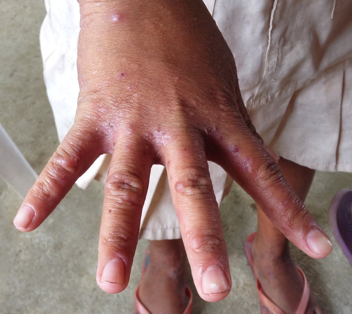 Scabies skin lesions
