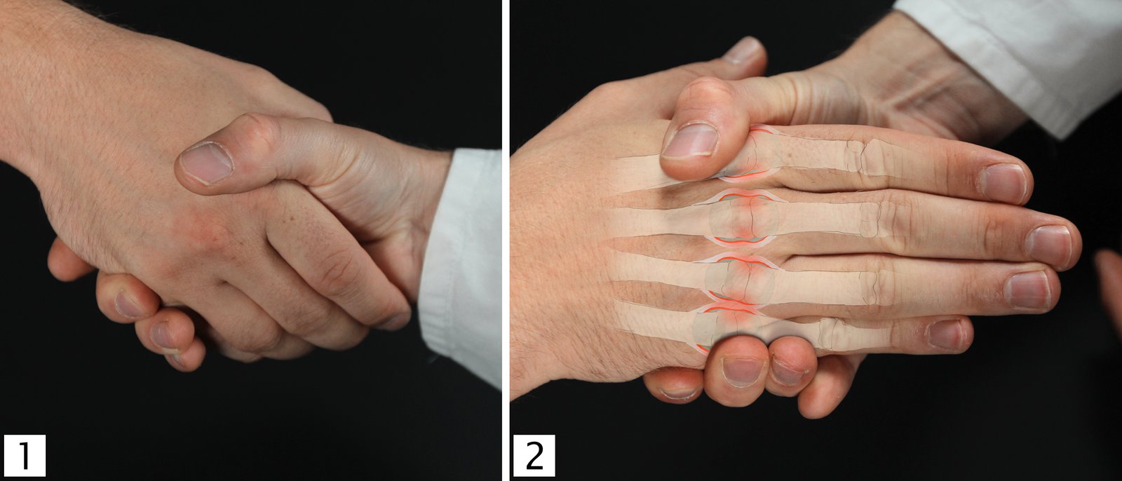 Compression test (Gaenslen squeeze test)