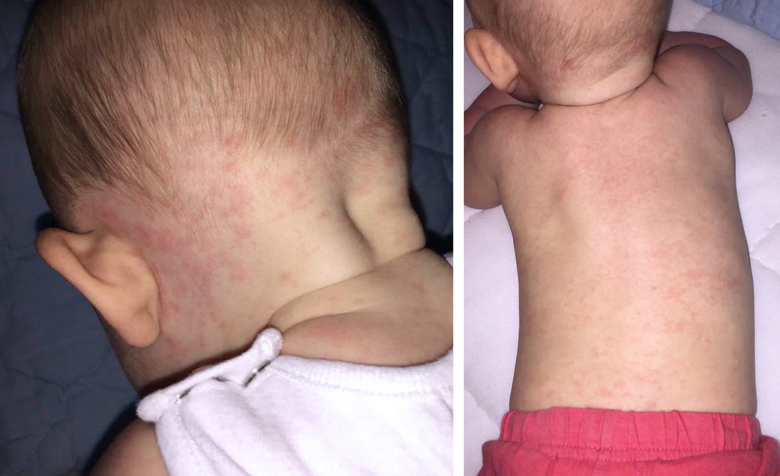 Roseola infantum (exanthem subitum)