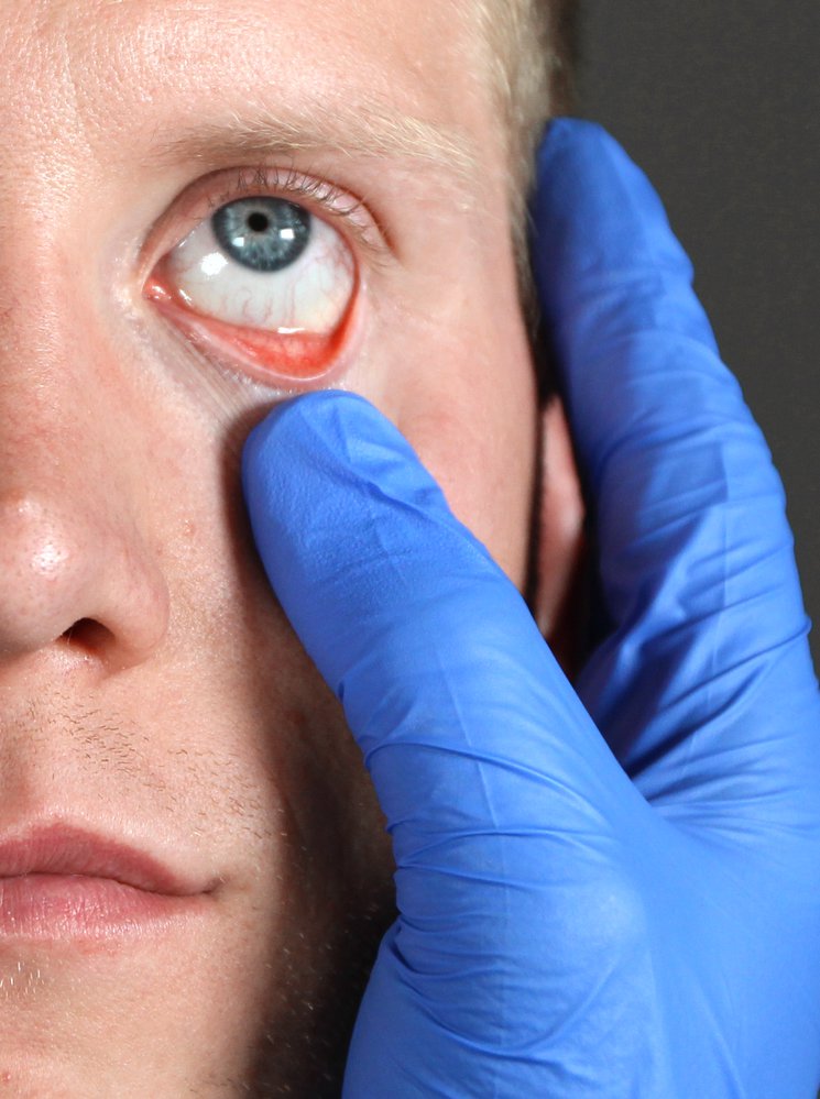 Examination of the conjunctiva
