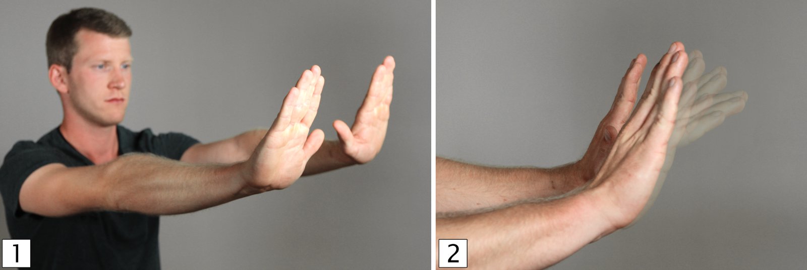 Asterixis (flapping tremor)