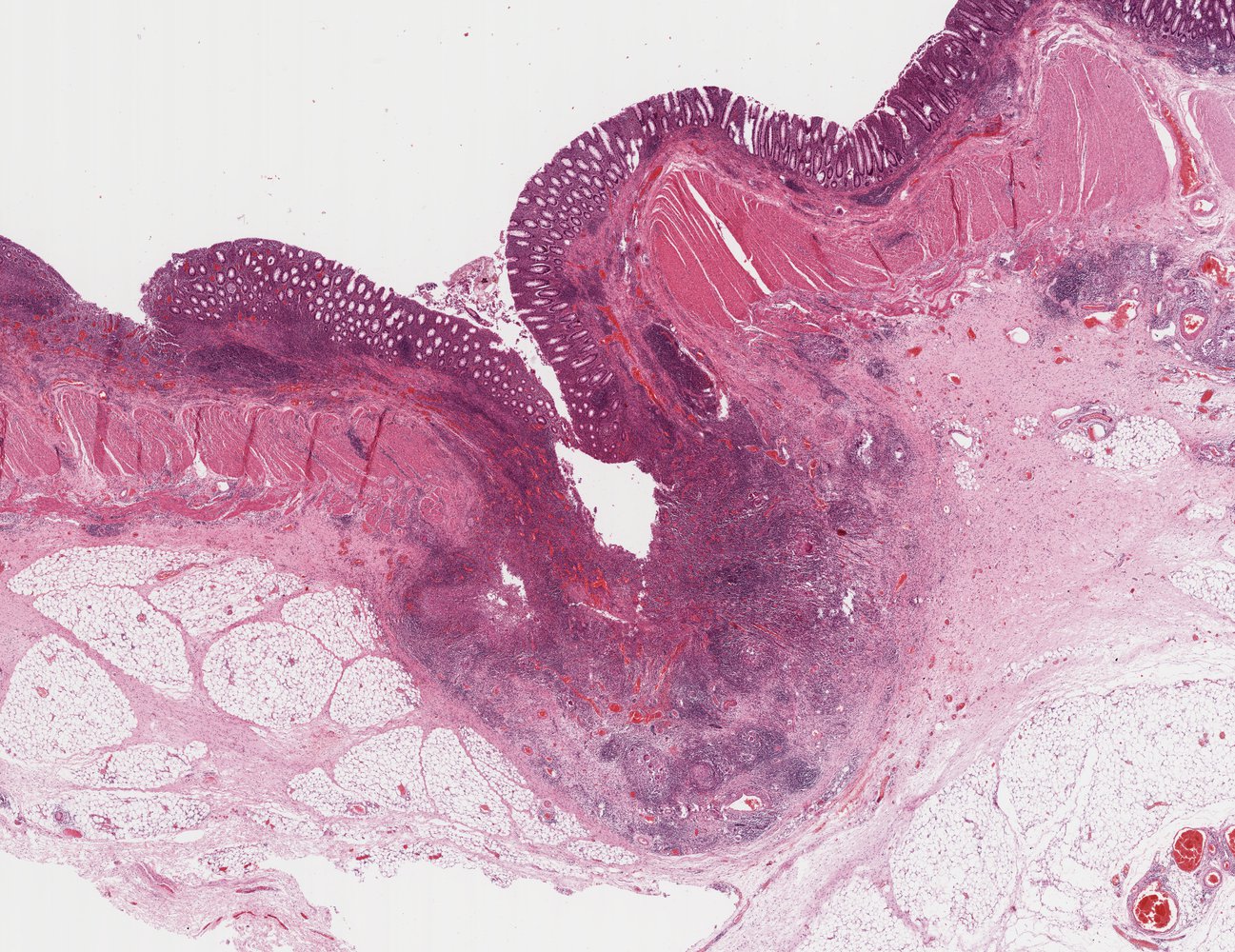 Crohn disease