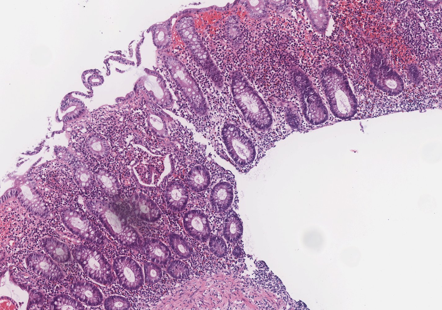 Ulcerative colitis