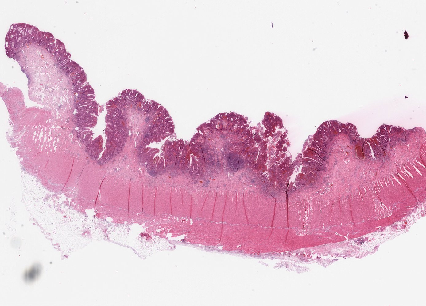 Ulcerative colitis