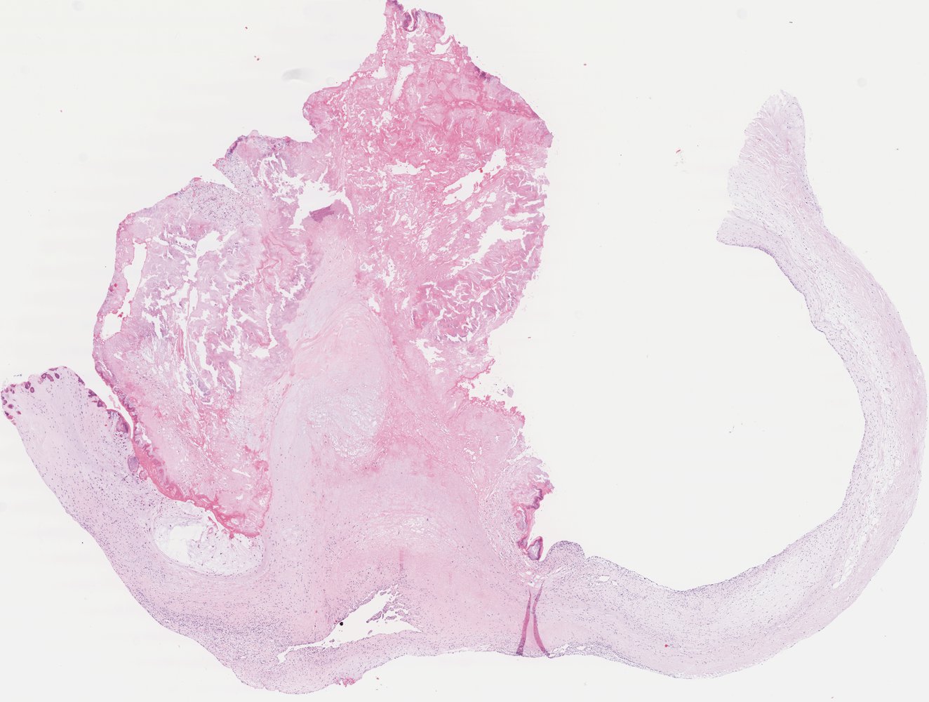 Infective endocarditis of the aortic valve