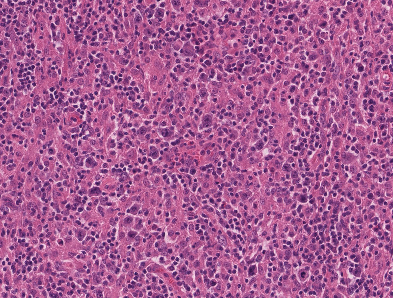 Hodgkin lymphoma