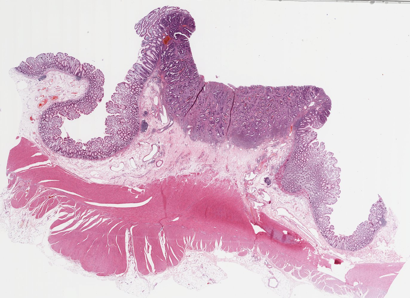 Colorectal adenocarcinoma (pT1)