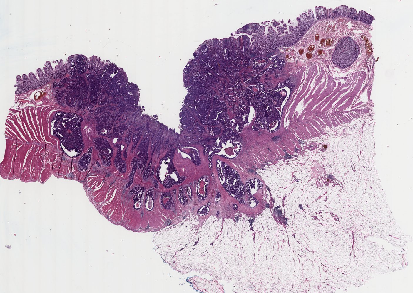 Colorectal adenocarcinoma (pT3)
