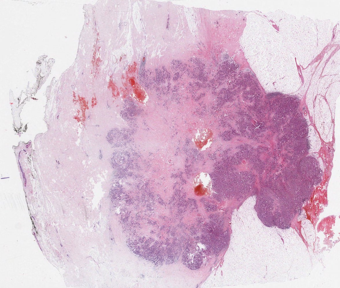 Invasive ductal carcinoma of the breast