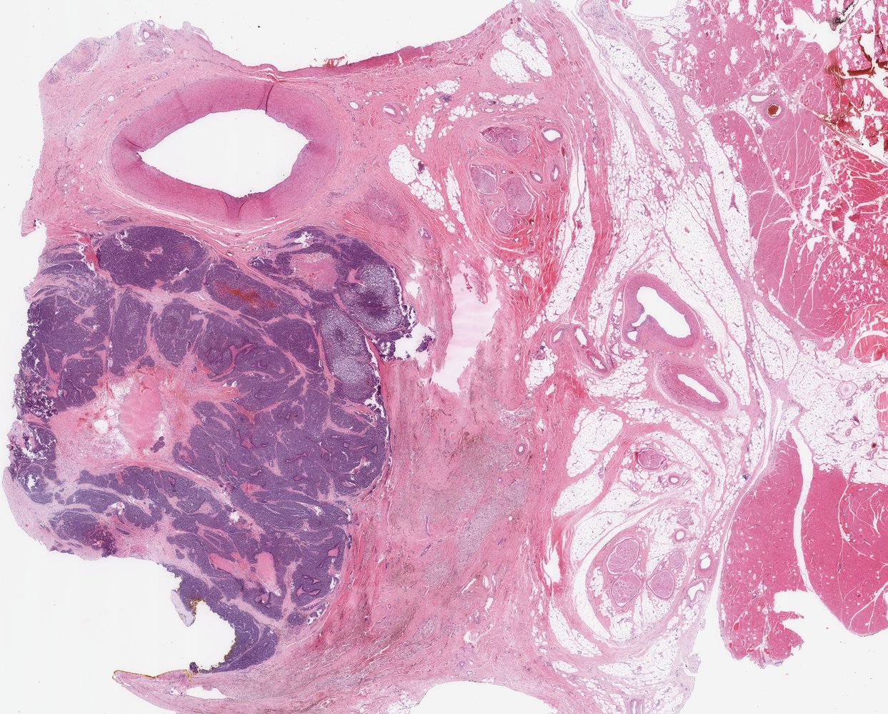 Ewing sarcoma