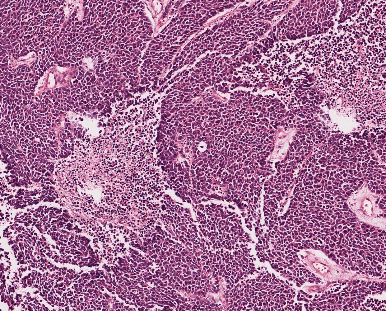 Small cell lung carcinoma