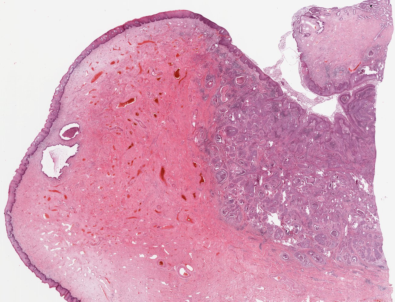 Squamous cell carcinoma of the cervix