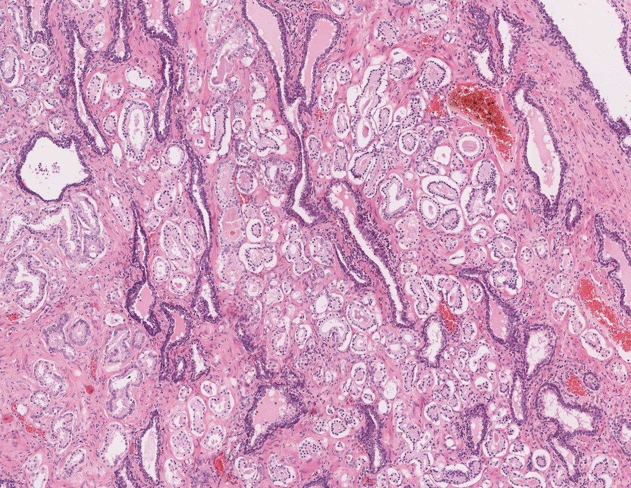 Adenocarcinoma of the prostate (resection specimen)