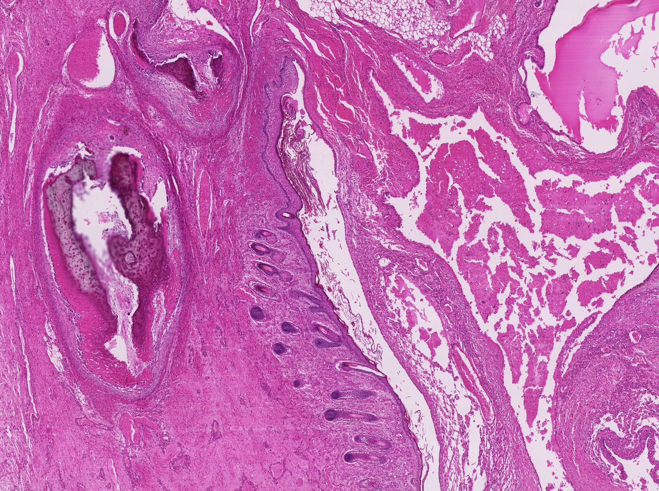 Mature teratoma of the ovary