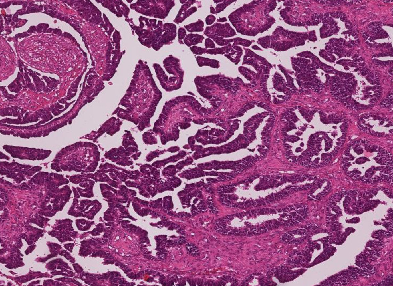 High-grade serous carcinoma of ovary
