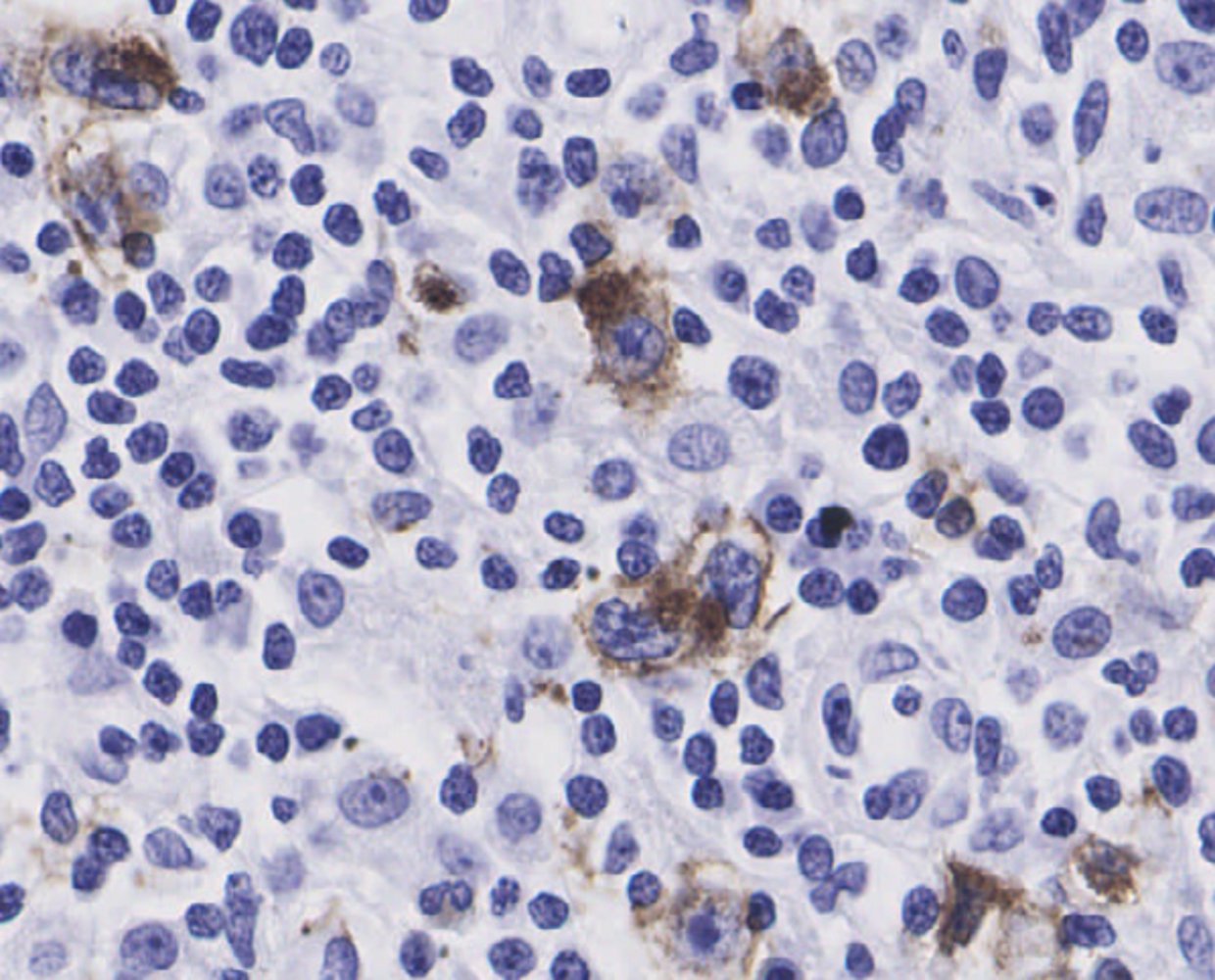 Hodgkin lymphoma (immunohistochemistry for CD30)